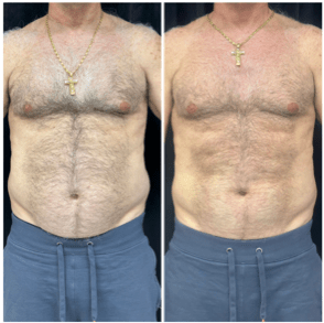 a before and after picture of a man's frontal body with truSculpt