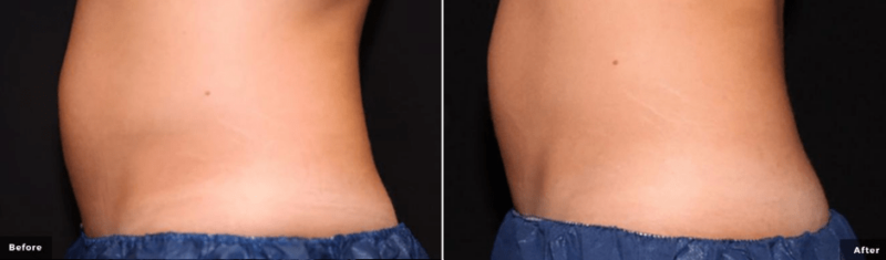 a before and after picture of a womans stomach smooth curvilinear design