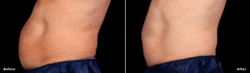 a before and after picture of a womans stomach smooth curvilinear design2