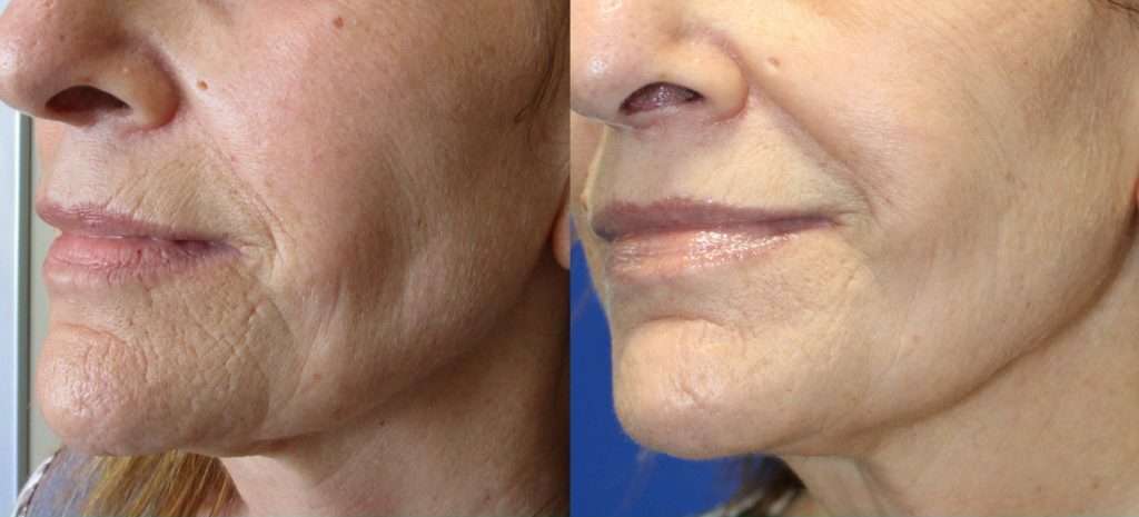 before and after result of secret rf treatment