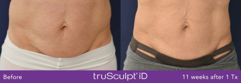 persons belly shows result of before and after trusculpt id