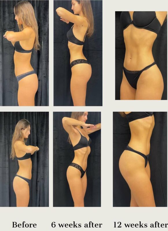 the before and after pictures of a womans abdomen with trusculpt id