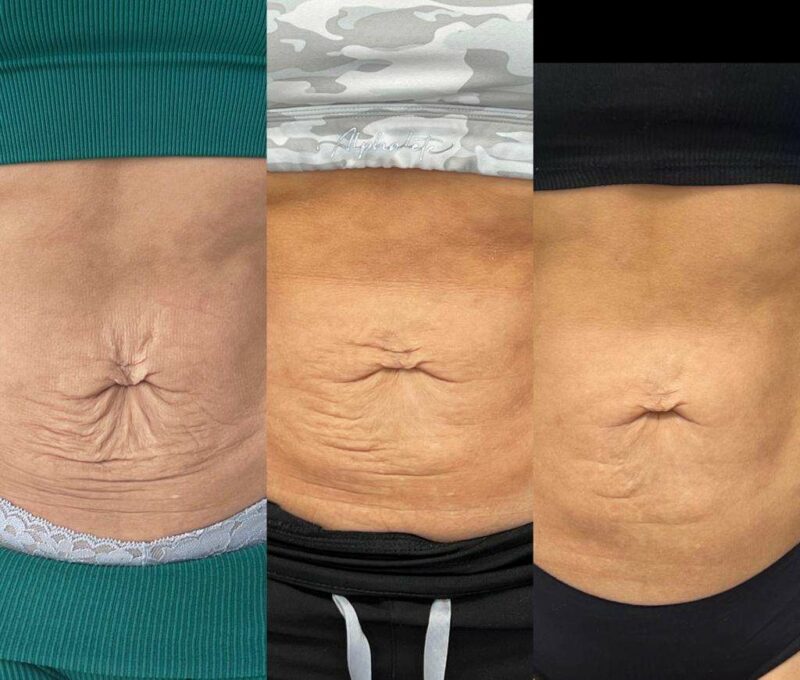womans belly showing result before and after trusculpt
