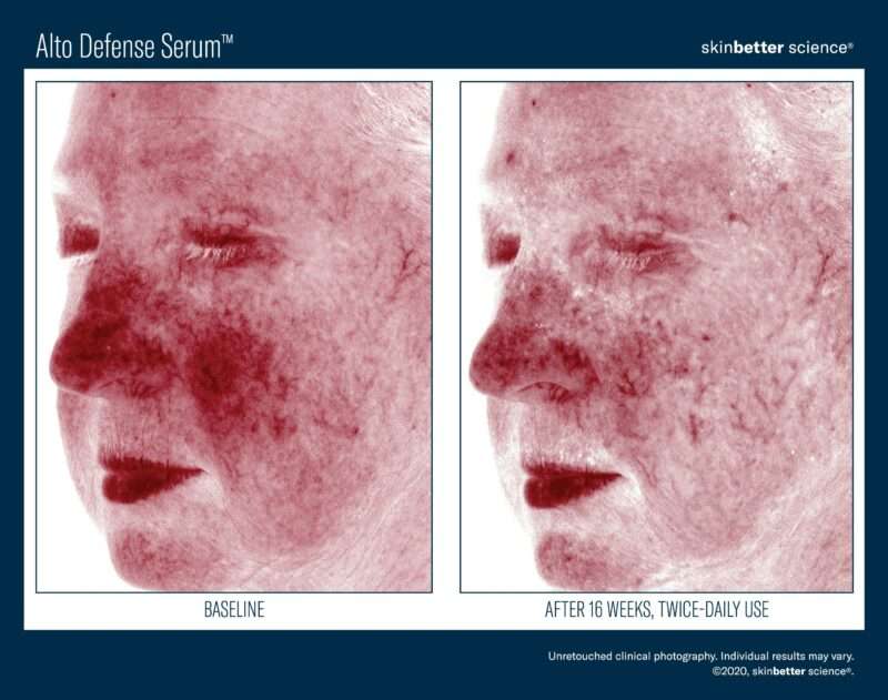 woman's face shows before and after result of alto defense serum