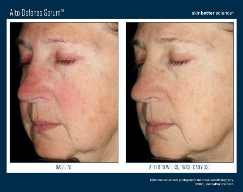 woman's face shows before and after result of alto defense serum