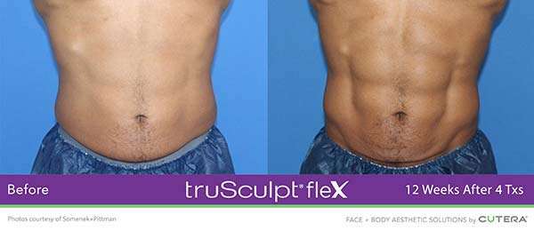 a mans abdomen showing before and after result of trusculpt