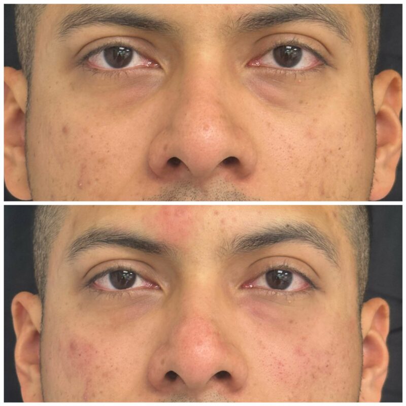 a mans face showing before and after result of dermal fillers 1