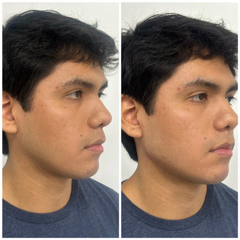 a mans face showing before and after result of jawline chin contouring 5