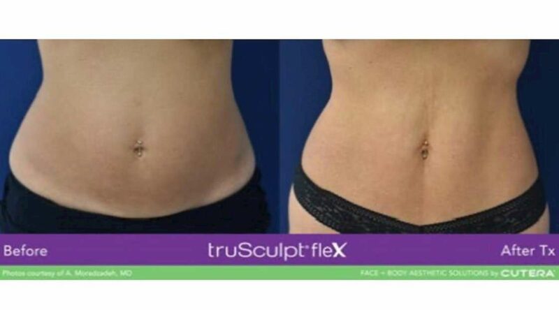 a womans belly showing before and after result of trusculpt 1