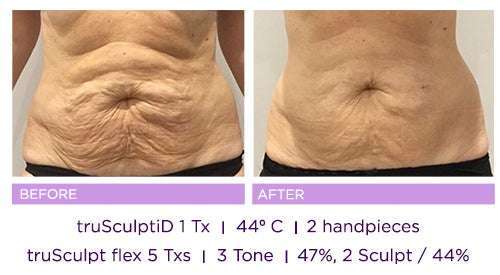 A woman's belly showing before and after result of truSculpt iD