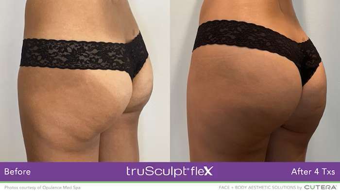 A woman's butt wearing lingerie showing before and after result of truSculpt
