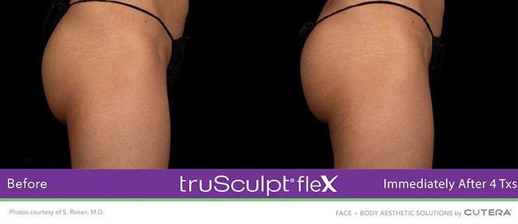 a womans butt wearing lingerie showing before and after result of trusculpt 2