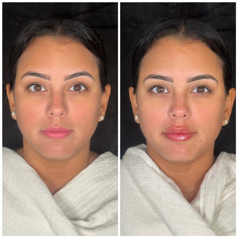 a womans face showing before and after result of dermal fillers 2