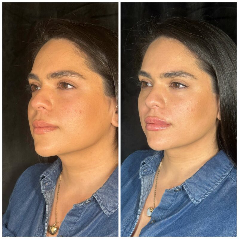 a womans face showing before and after result of dermal fillers 3