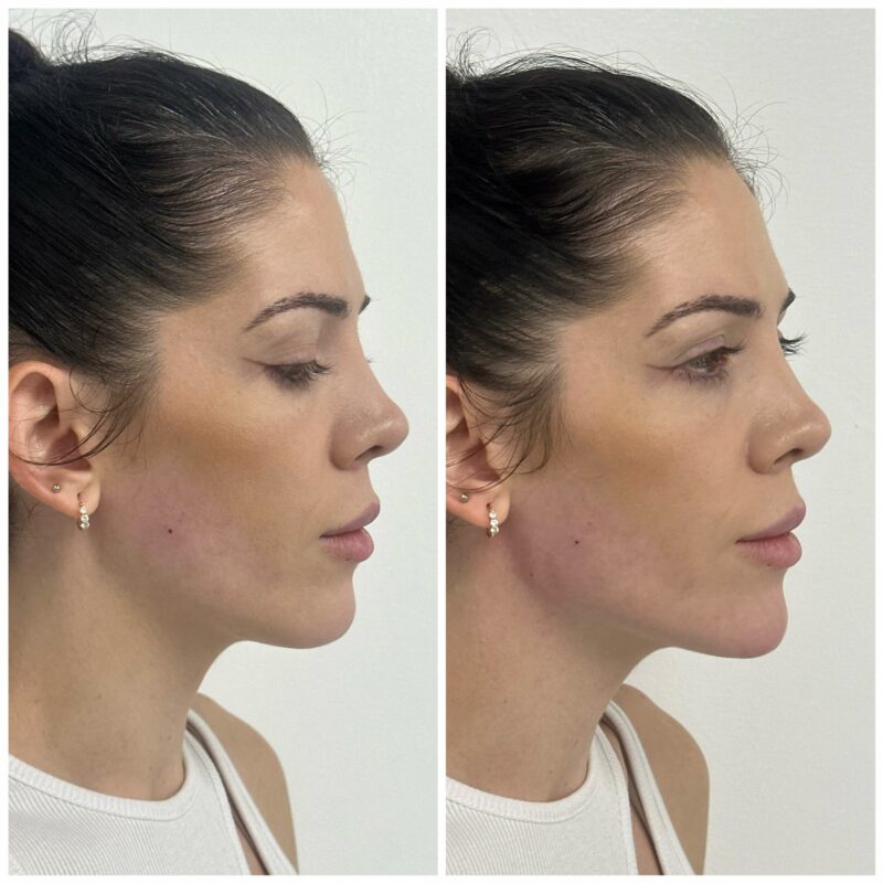 a womans face showing before and after result of jawline chin contouring 10
