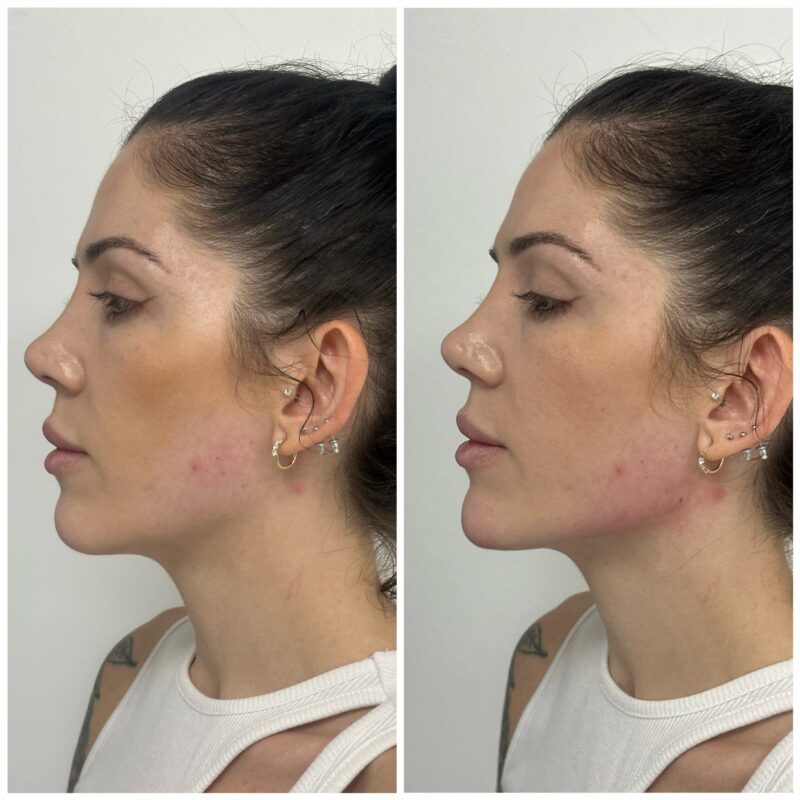 a womans face showing before and after result of jawline chin contouring 11