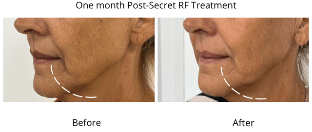 a womans face showing before and after result of secret rf 1