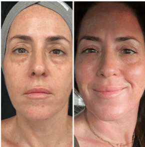 a woman's face showing before and after result of Secret RF