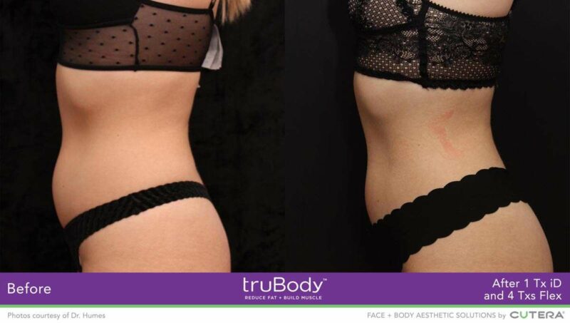 a womans mid section showing before and after result of trubody procedure 1