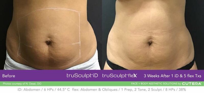 a womans mid section showing before and after result of trusculpt id and flex procedure 1