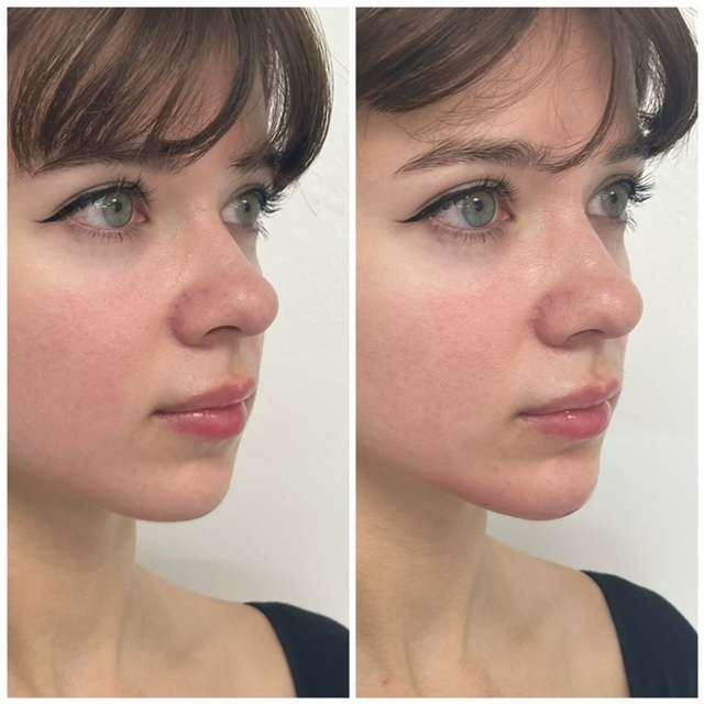 before and after result of Chin contouring