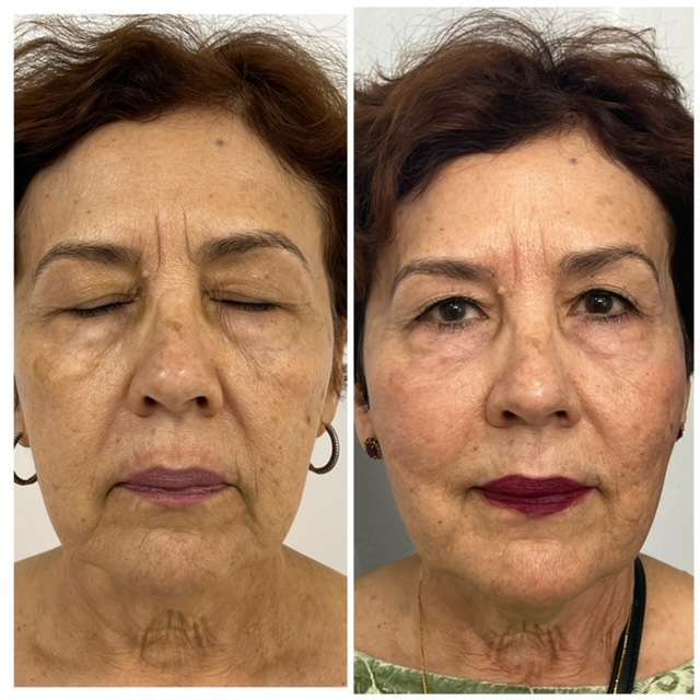 before and after result of facial balancing