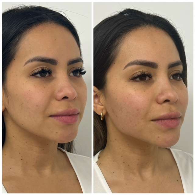 before and after result of facial balancing