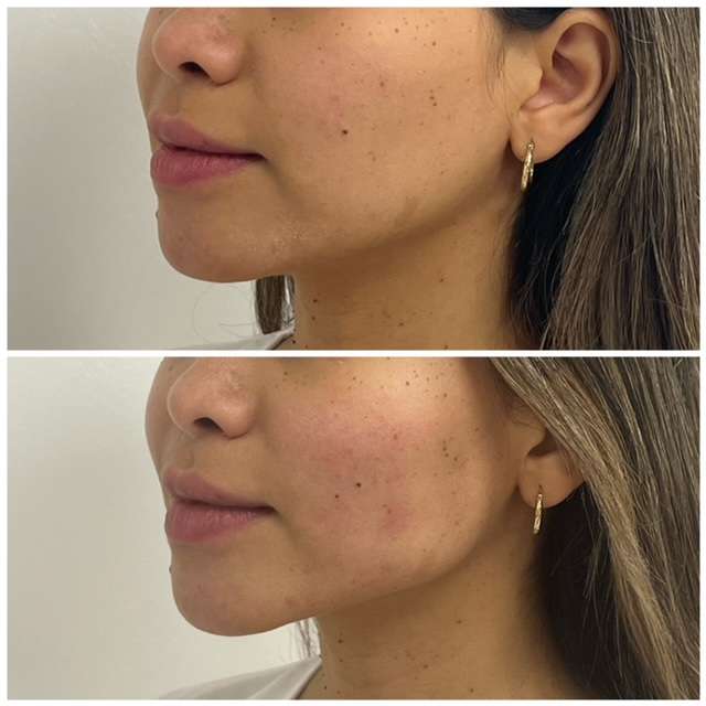 before and after result of jawline contouring 1