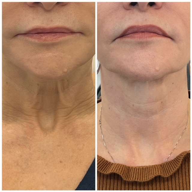 before and after result of neck rejuvenation
