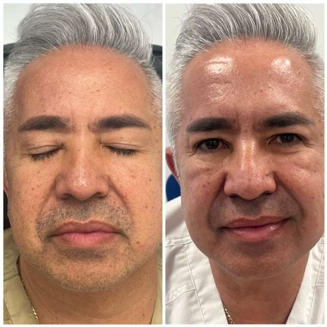 mans face showing result of before and after chemical peel procedure