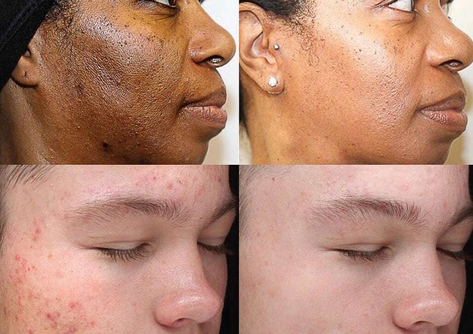 photo of two individual persons face showing before and after result of chemical peel 1