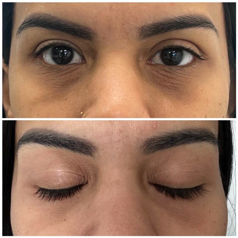 womans eyelid showing before and after result of chemical peel 1