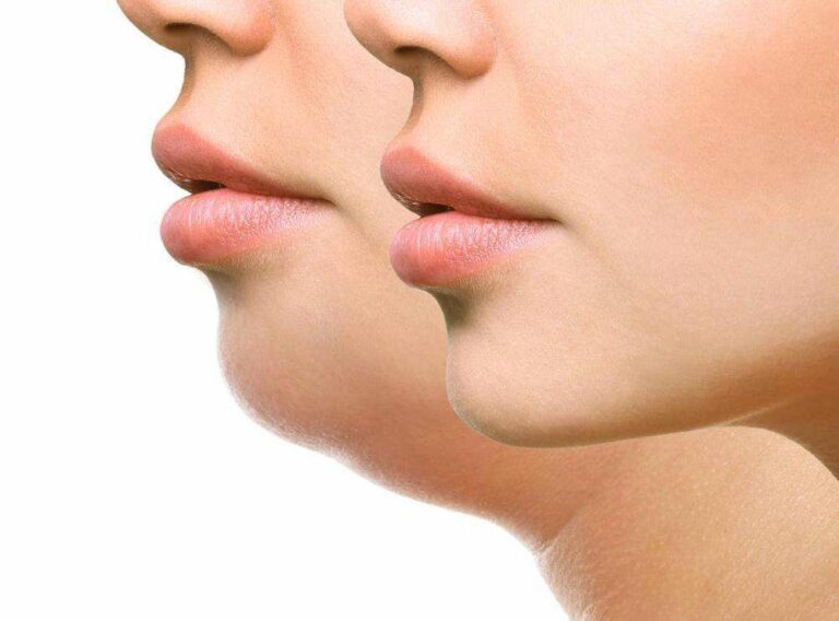 a woman showing before and after jawline chin contouring 1