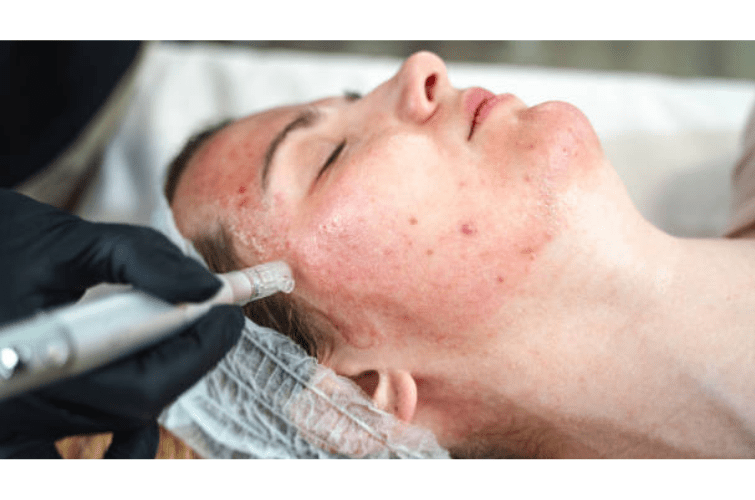 a person getting an acne scars treatment in a salon