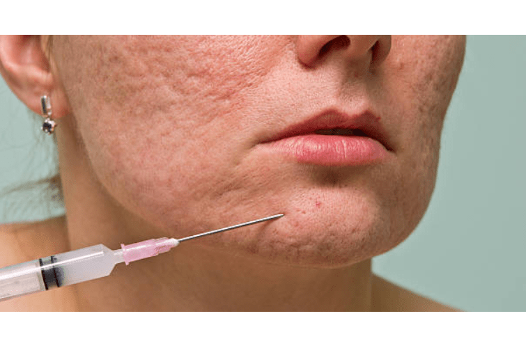 a person with acne on their face is being treated with an injection