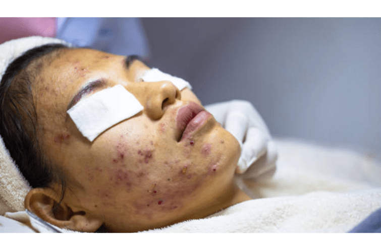 a person with acne on their face getting a facial treatment