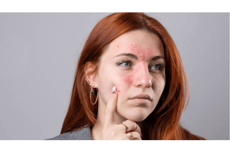 a person with facial redness their face