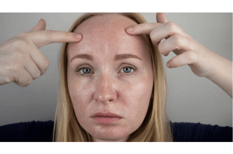 a woman with her hands on her forehead pointing her pigmentation issues