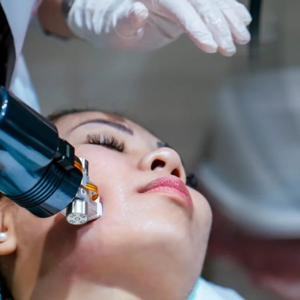 woman's face getting radiofrequency microneedling