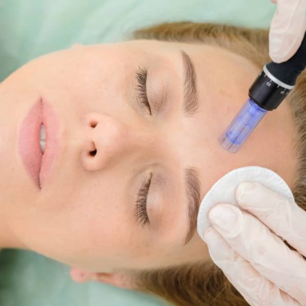 woman's face getting microneedling treatment